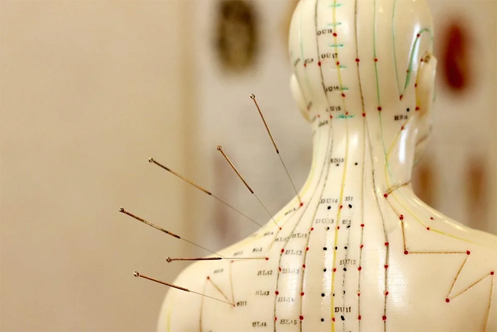 Tratamiento de acupuntura