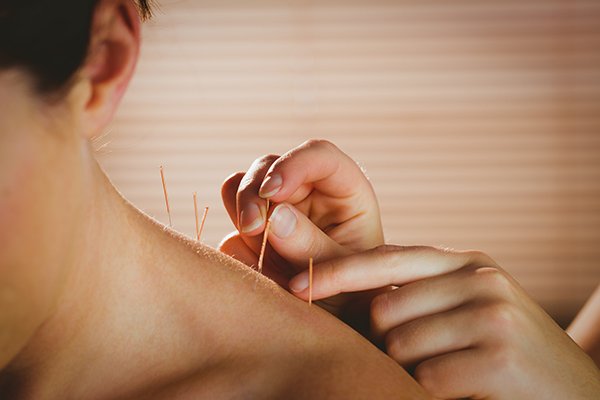 Practica Acupuntura